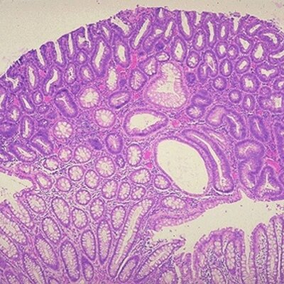 Hereditary Pathology